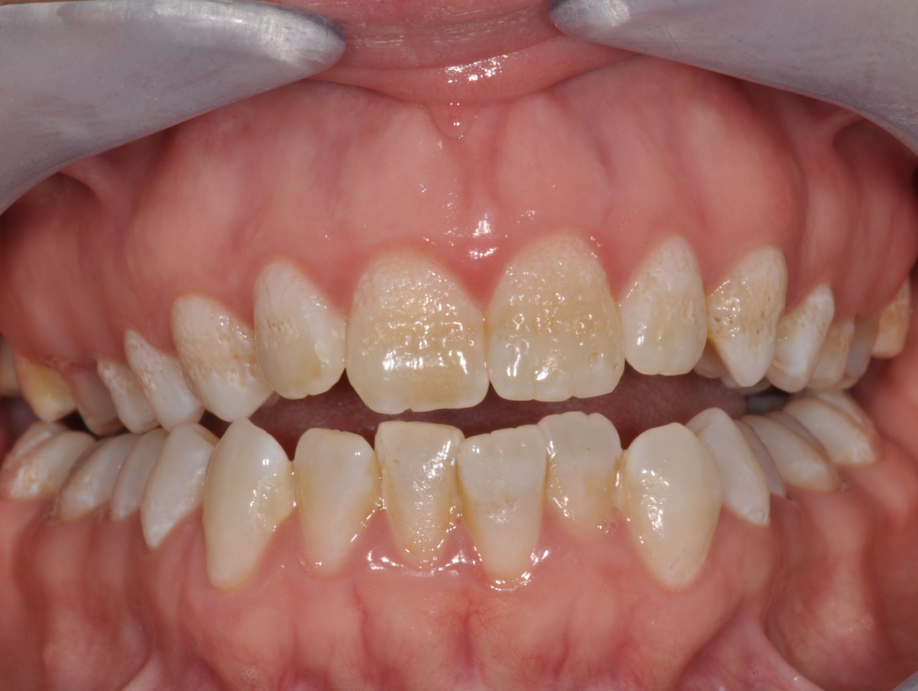 Generalisierte Schmelzanomalie